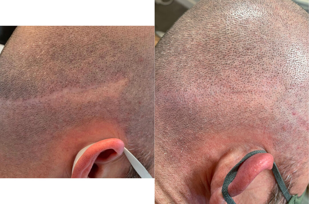 Medical Tattooing Before and After Photo by Dr. Emer in West Hollywood California