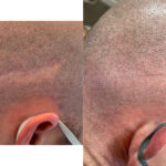 Medical Tattooing Before and After Photo by Dr. Emer in West Hollywood California