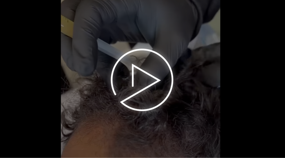 exosomes for hair restoration video thumbnail