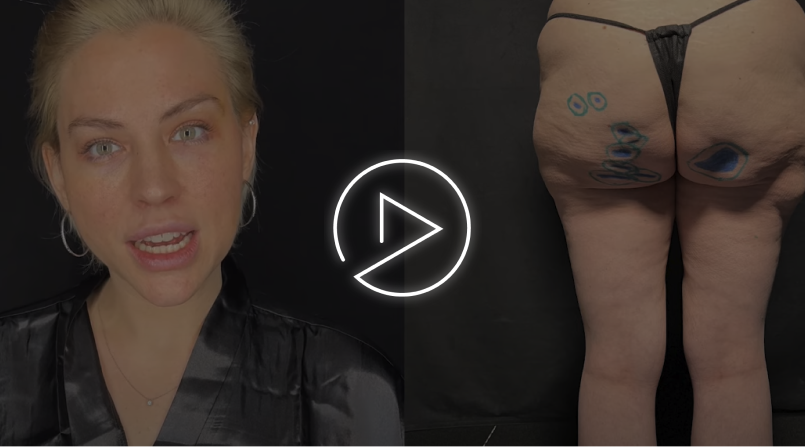 AVELI CONFIRMED TO CUT CELLULITE BANDS FOR SMOOTH BUTTOCK AND THIGHS PATIENT STORY | Dr. Jason Emer video thumbnail